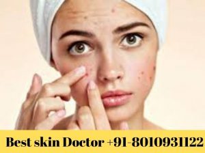 Best skin doctor Indraprastha 8010931122