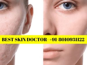 Best skin doctor Akshardham 8010931122