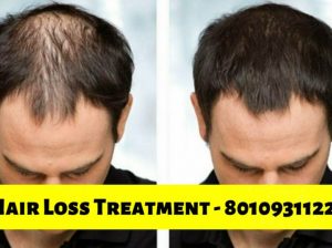 Hair Loss/Fall Treatment in gurgaon 8010931122