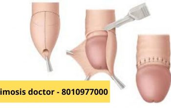 Phimosis treatments in Kailash Colony 8010977000
