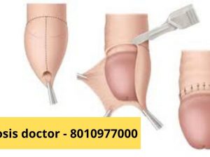 8010977000 Ayurvedic Doctors For Phimosis Treatment Moolchand